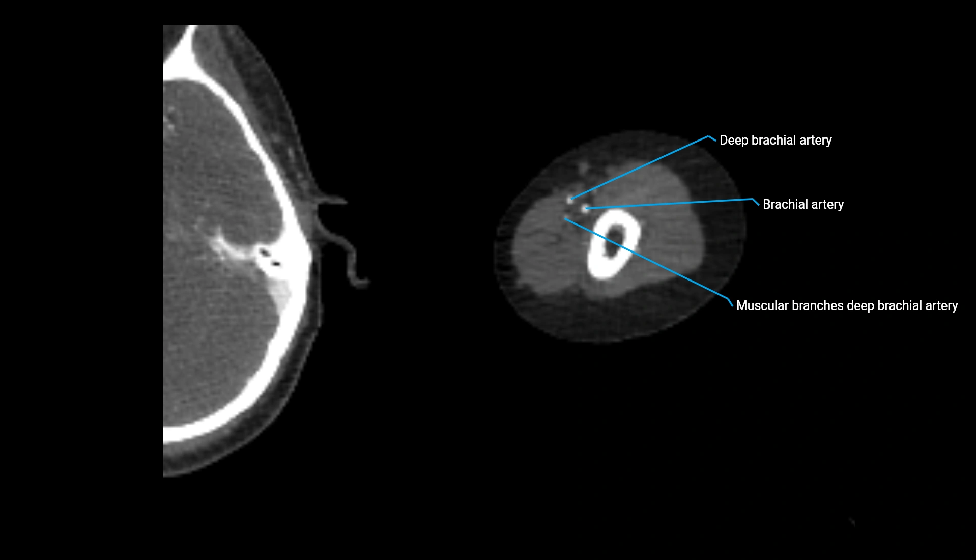 CTA upper limb axial cross sectional anatomy labelled image 256 (2).webp